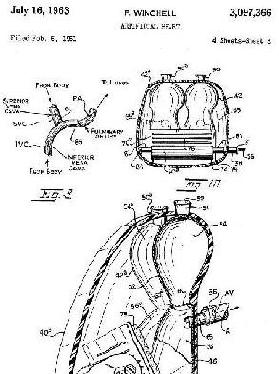 Another view of his artificial heart